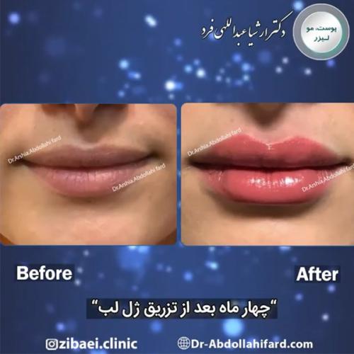 تزریق-ژل-در-تهران-76