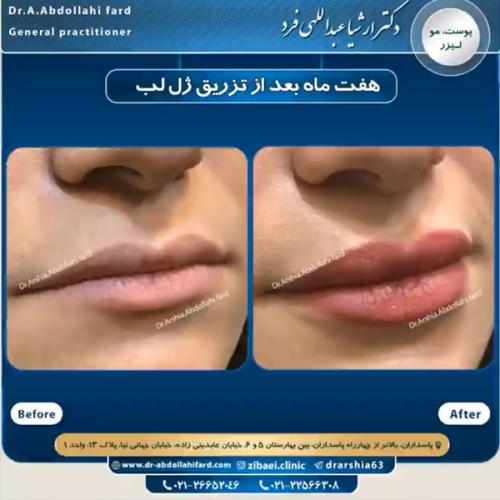 تزریق-ژل-در-تهران-77