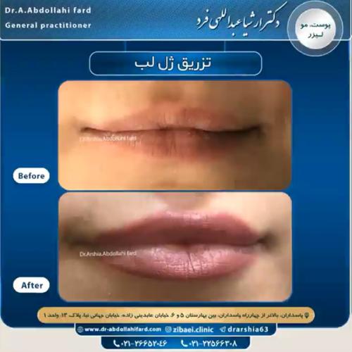 تزریق-ژل-در-تهران-78
