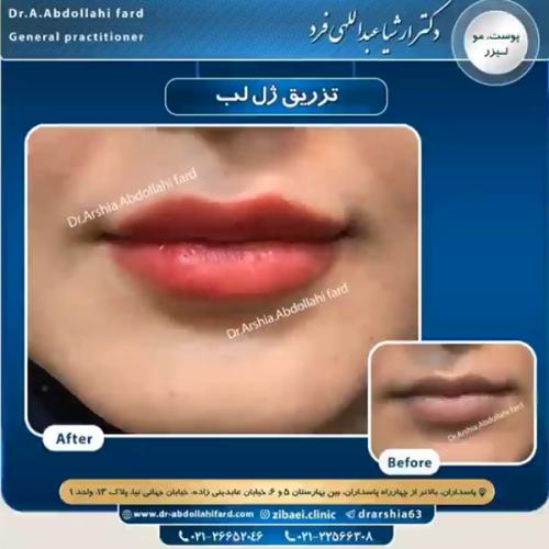 تزریق-ژل-در-تهران-79