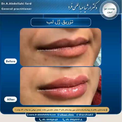 تزریق-ژل-در-تهران-80