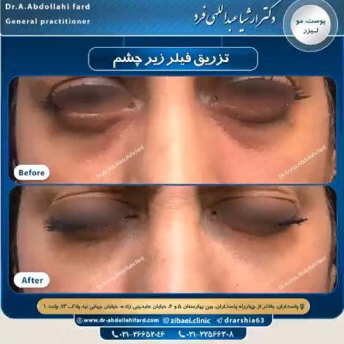 تزریق-ژل-در-تهران-84