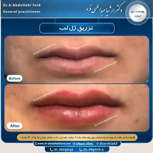 تزریق-ژل-در-تهران-85