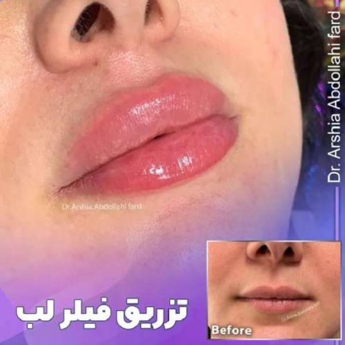 تزریق-ژل-در-تهران-93