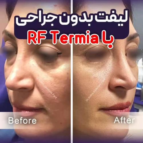 لیفت-صورت-12-