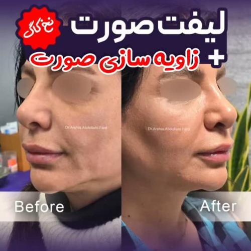 لیفت-صورت-13