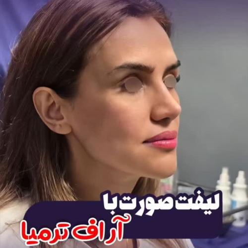 لیفت-صورت-14