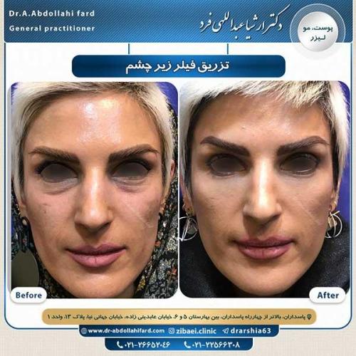 تزریق-فیلر-زیر-چشم-1