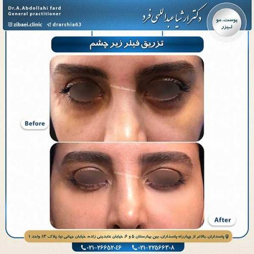 تزریق-فیلر-زیر-چشم-2