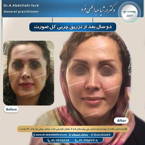 تزریق-چربی-1