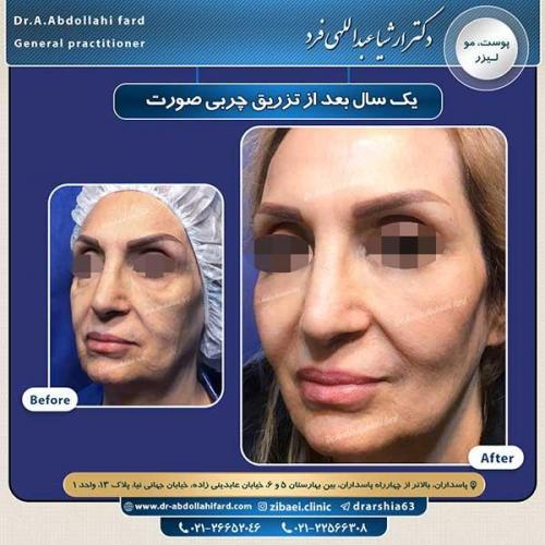 تزریق-چربی-10