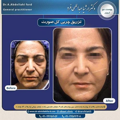 تزریق-چربی-11