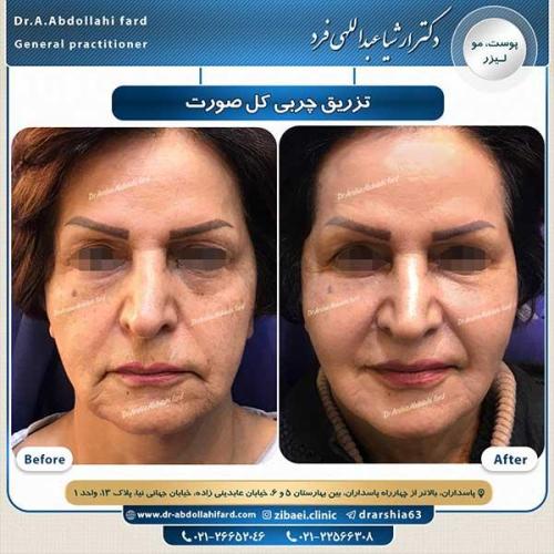 تزریق-چربی-3