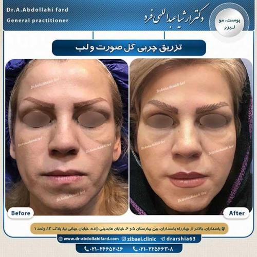 تزریق-چربی-4