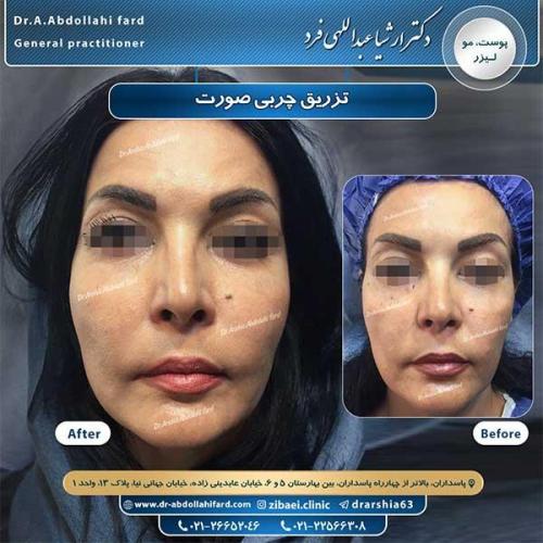 تزریق-چربی-5