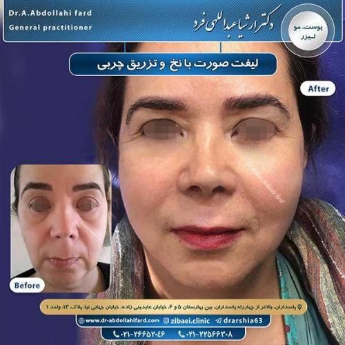 تزریق-چربی-6