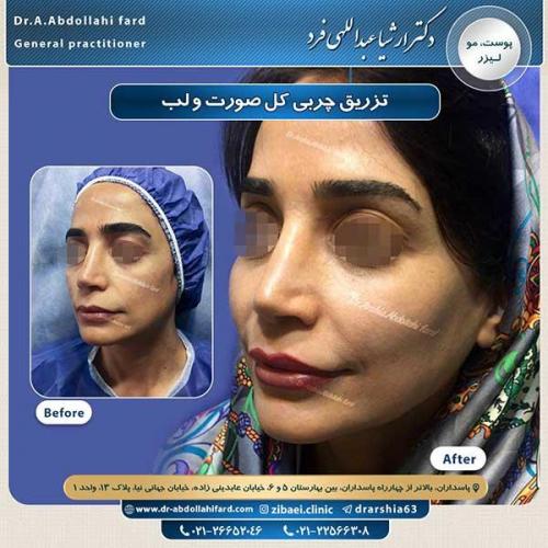 تزریق-چربی-8