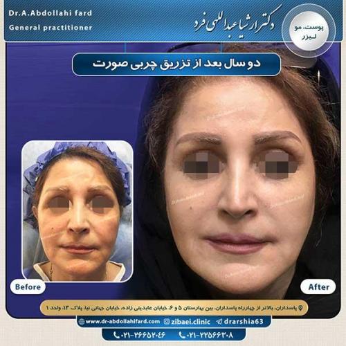 تزریق-چربی-9