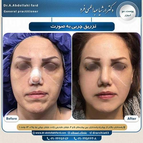 تزریق-چربی-به-صورت-1