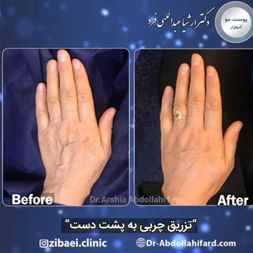 تزریق-چربی-در-تهران-59