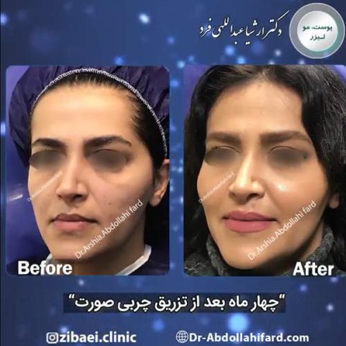 تزریق-چربی-در-تهران-60