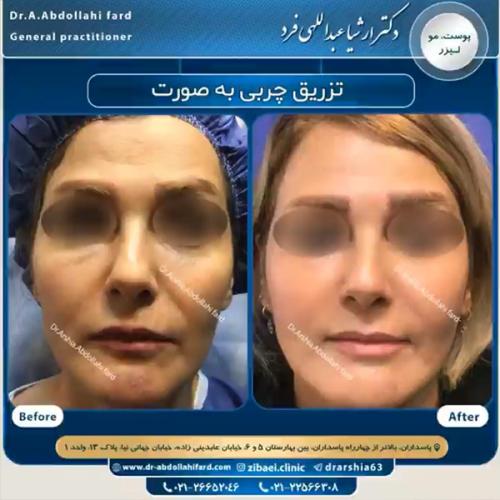 تزریق-چربی-در-تهران-61