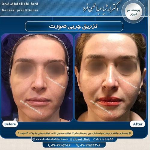 تزریق-چربی-در-تهران-62