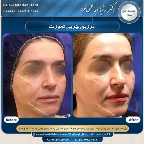 تزریق-چربی-در-تهران-63