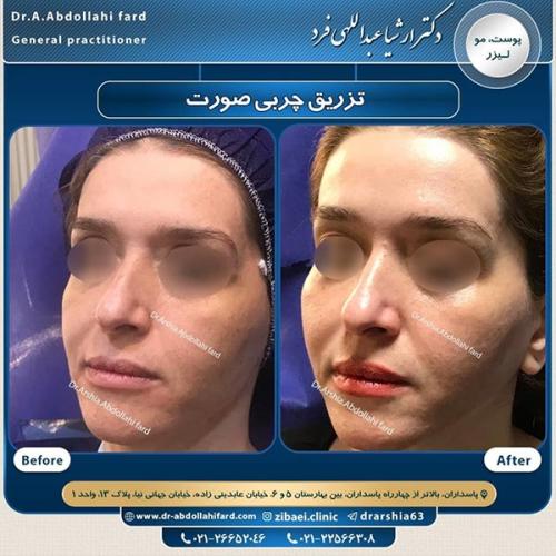 تزریق-چربی-در-تهران-64