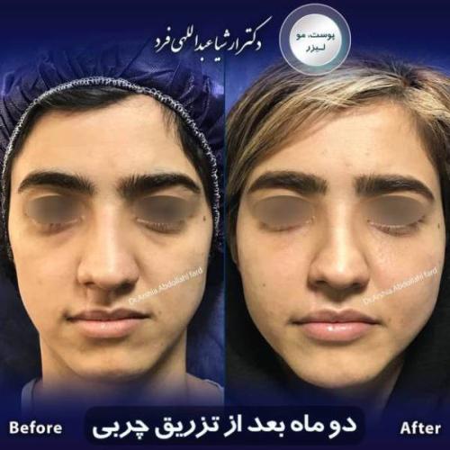 تزریق-چربی-در-تهران-67