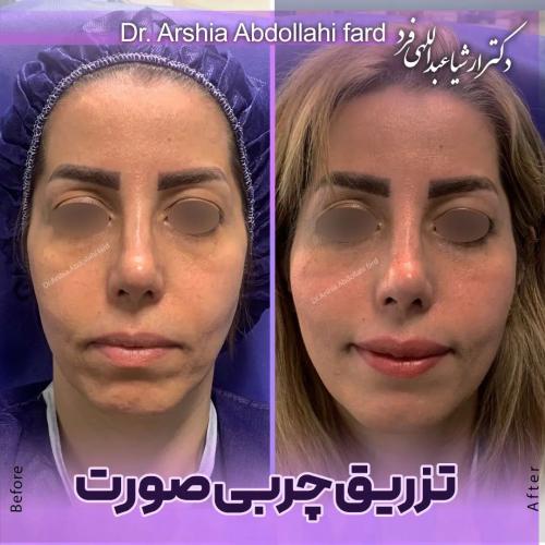 تزریق-چربی-در-تهران-75