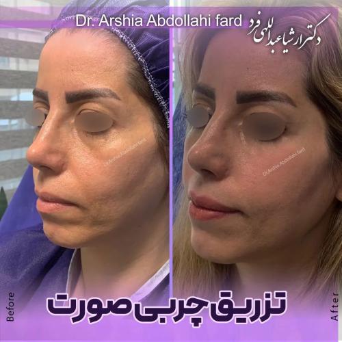 تزریق-چربی-در-تهران-76