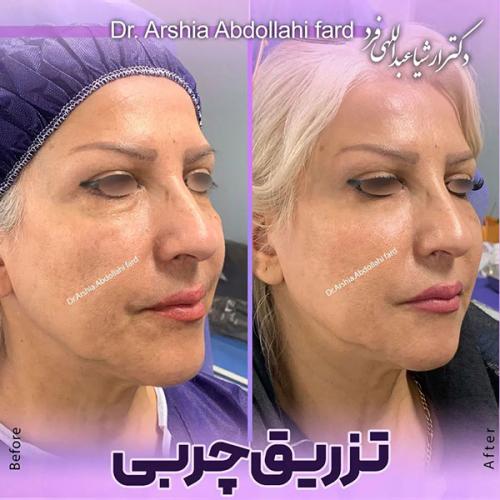 تزریق-چربی-در-تهران-77