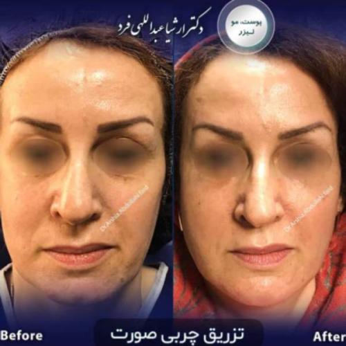 تزریق-چربی-در-تهران65