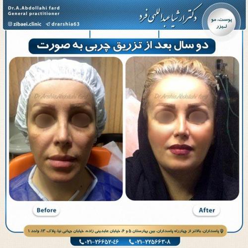 تزریق چربی 1