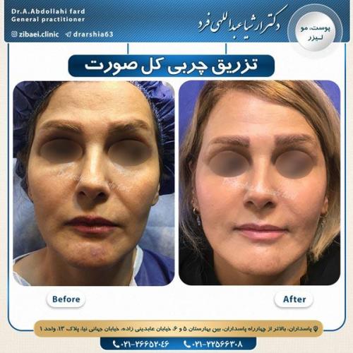 تزریق چربی 10