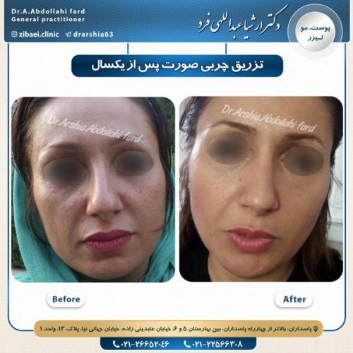 تزریق چربی 12