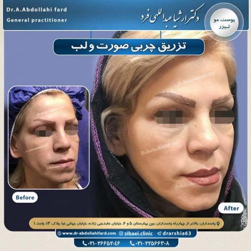 تزریق چربی 13