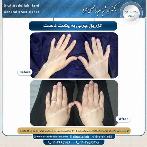 تزریق چربی 14