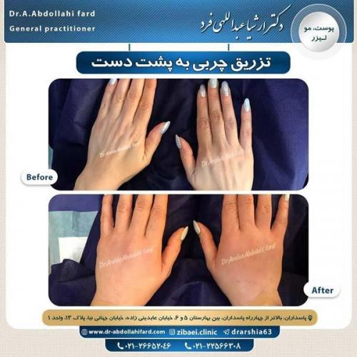 تزریق چربی 15