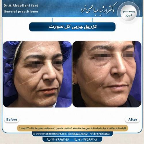 تزریق چربی 16