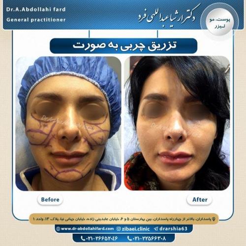 تزریق چربی 2