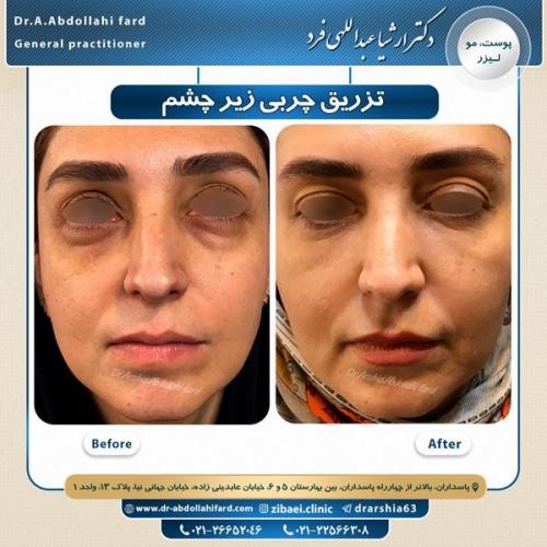 تزریق چربی 3