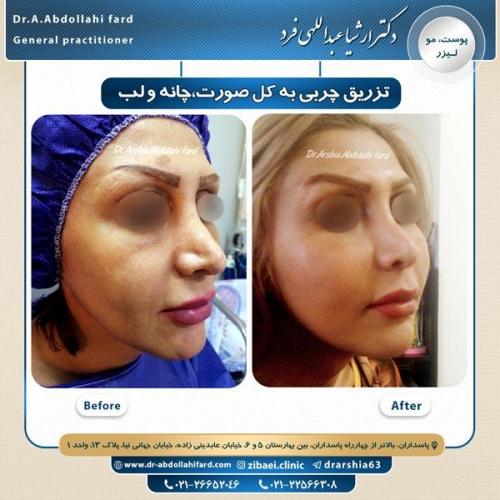 تزریق چربی 4