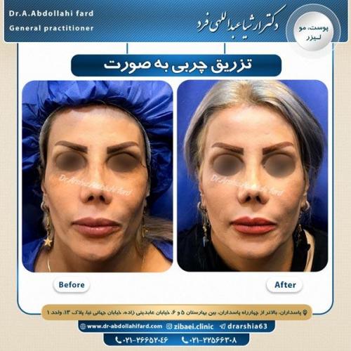 تزریق چربی 5