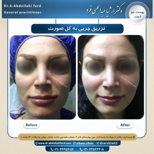 تزریق چربی 6