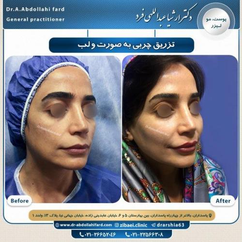 تزریق چربی 7