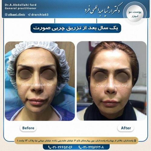 تزریق چربی 9
