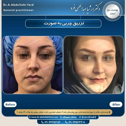 تزریق چربی در تهران 31