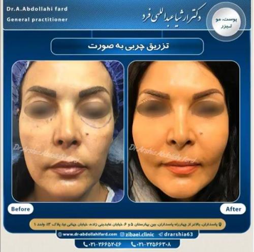 تزریق چربی در تهران 32